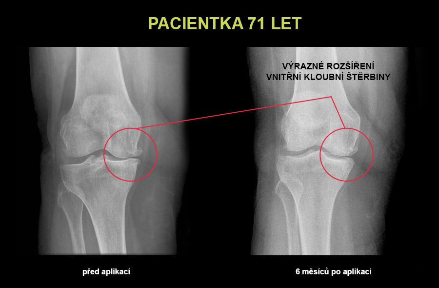 artróza kolene léčba