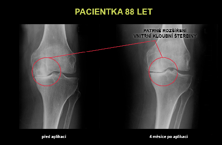 Snímky kloubů z léčby kloubů Ostrava, Praha, Bratislava
