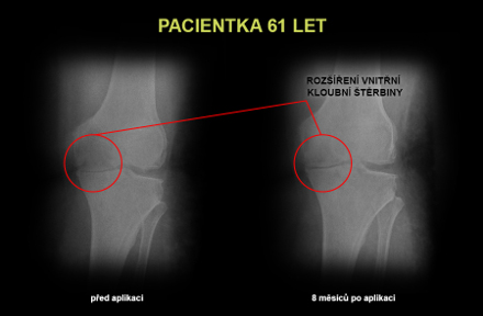 Snímky kloubů z léčby kloubů Ostrava, Praha, Bratislava