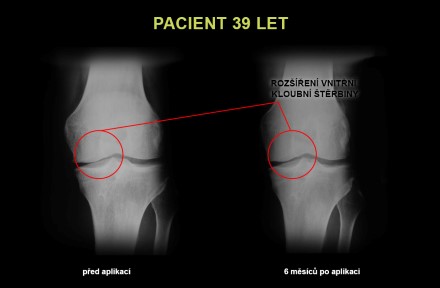 Snímky kloubů z léčby kloubů Ostrava, Praha, Bratislava