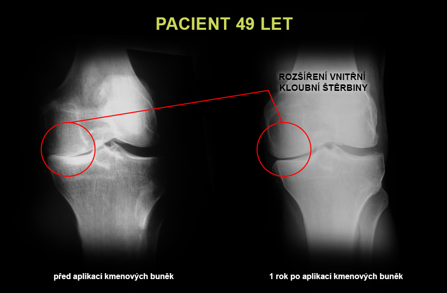 artroza ii stupně artroza și osteoartrita tratamentului gâtului